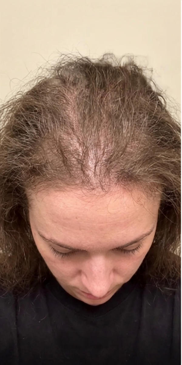 Jessica R. before